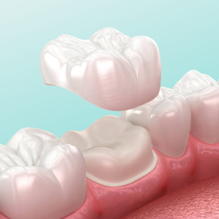 protese-fixa-coroa-dentaria-unique-recife-dentista-