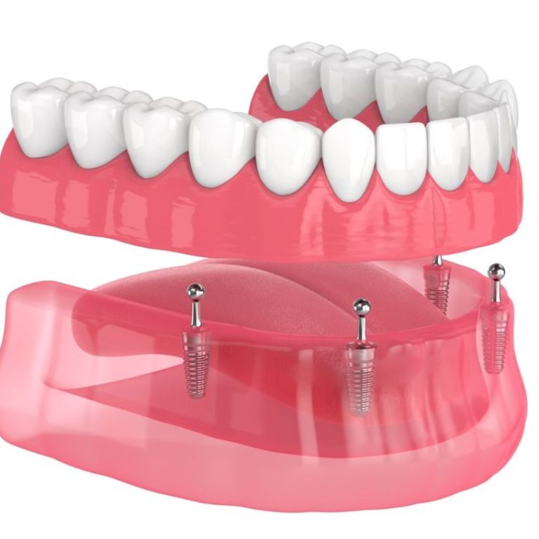 Prótese fixa para reabilitação dentária em unique consultório recife-PE