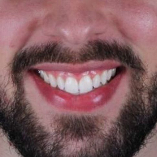 resultado-clareamento-dentista-unique-recife-2_2